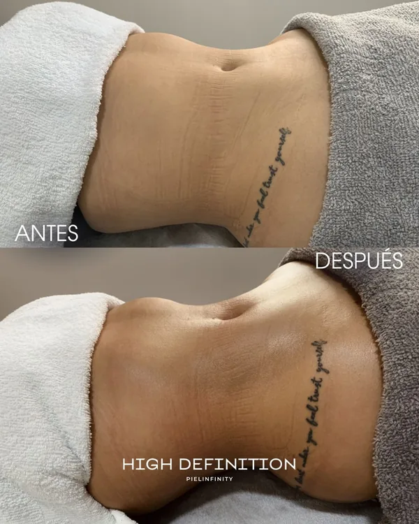 Antes y después del plan High Definition en abdomen, resultado de una paciente de Piel Infinity